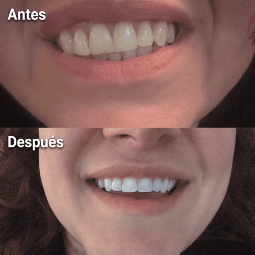 Amara™ | Sérum Blanqueador Dental