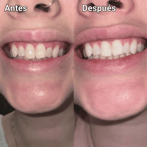Amara™ | Sérum Blanqueador Dental