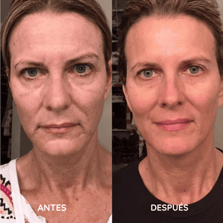 Amara™ | Set de Micro Infusión Anti-Edad