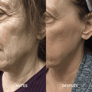 Amara™ | Set de Micro Infusión Anti-Edad