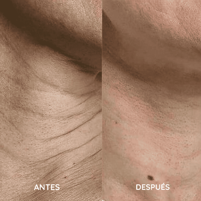 Amara™ | Set de Micro Infusión Anti-Edad
