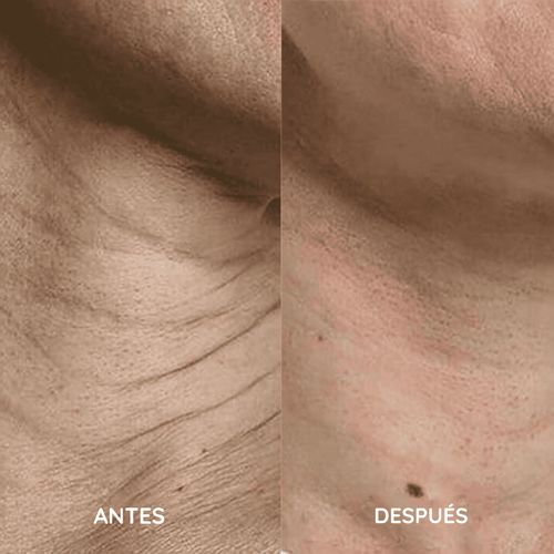 Amara™ | Set de Micro Infusión Anti-Edad
