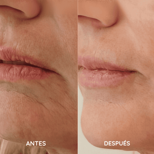 Amara™ | Set de Micro Infusión Anti-Edad