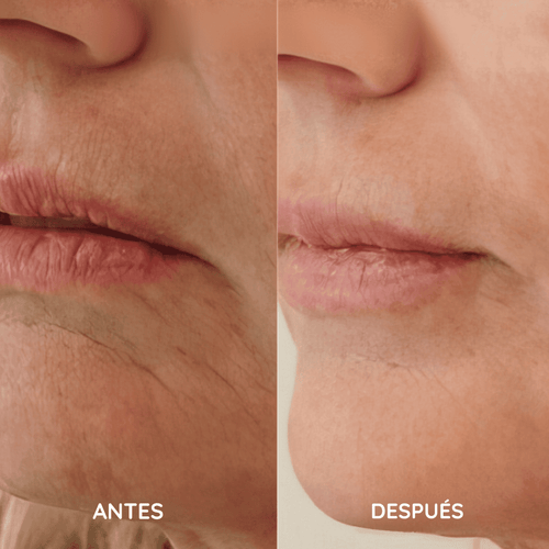 Amara™ | Set de Micro Infusión Anti-Edad