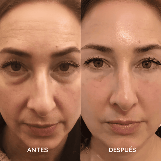 Amara™ | Set de Micro Infusión Anti-Edad
