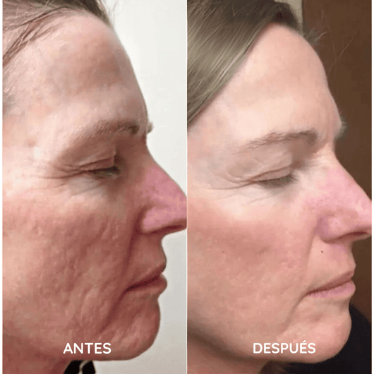 Amara™ | Set de Micro Infusión Anti-Edad