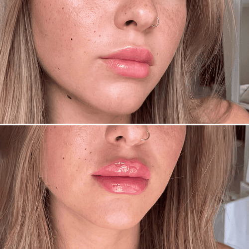Amara™ | Voluminizador de Labios con Ácido Hialurónico