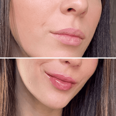 Amara™ | Voluminizador de Labios con Ácido Hialurónico