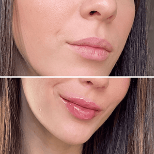 Amara™ | Voluminizador de Labios con Ácido Hialurónico