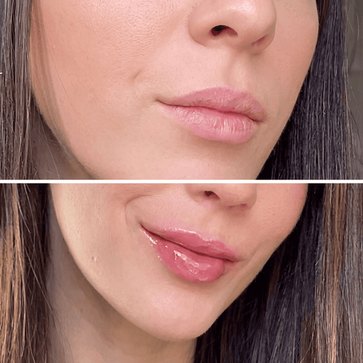 Amara™ | Voluminizador de Labios con Ácido Hialurónico